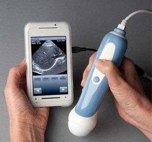 胎児の様子が分かるスマホ用の超音波カメラ