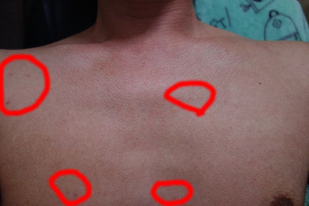 胸にできたニキビ